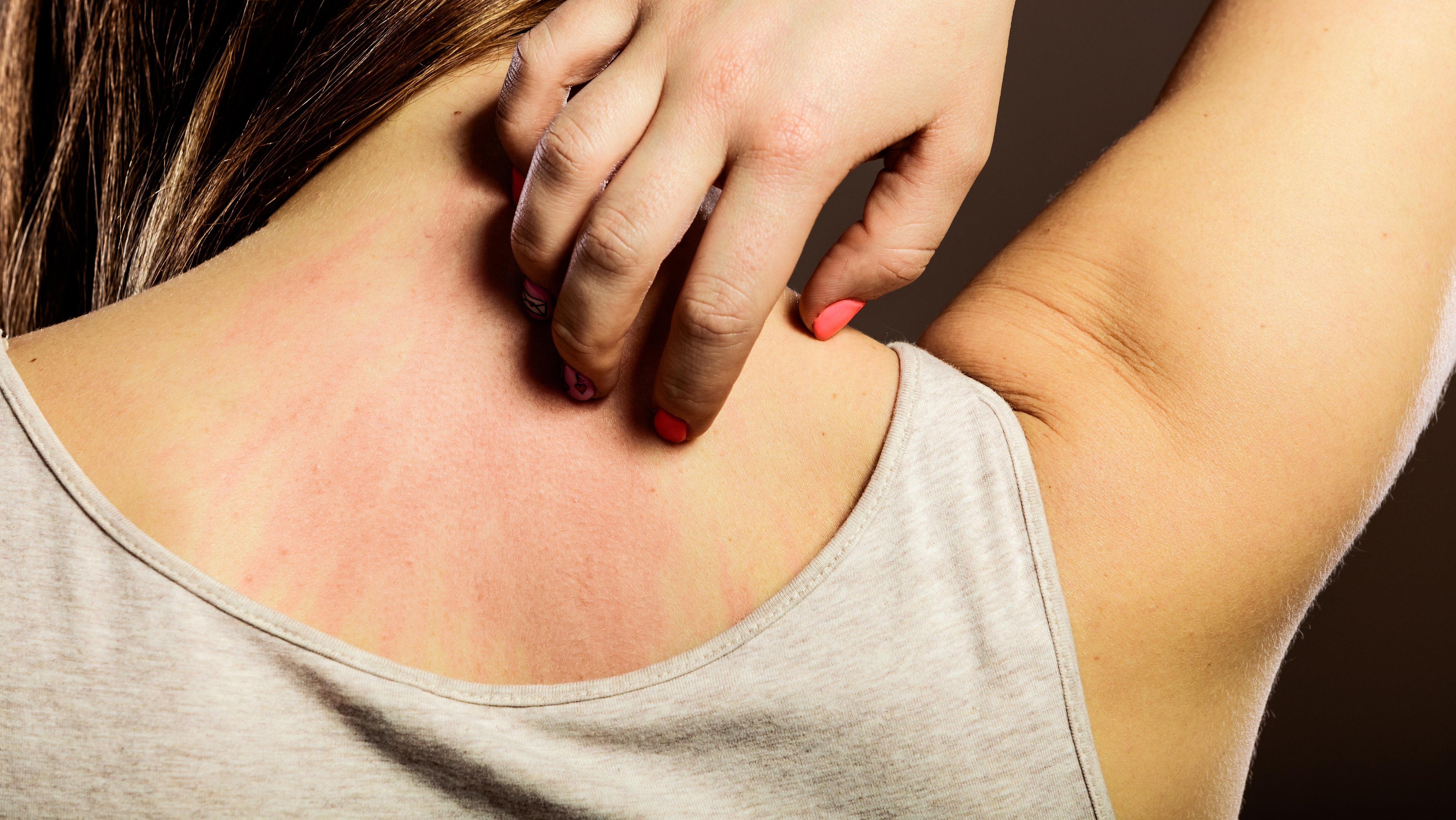 Allergi mot syntetiske stoffer